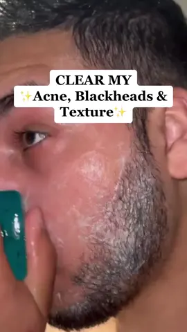 Skin Care Routine To Clear: Acne, Blackheads, Texture, Ingrown Hairs & Whiteheads🌟 #foryoupage #foryou #trending #acne #acneskin #skin #skincare #clearskin #hyperpigmentationtreatment #desi 