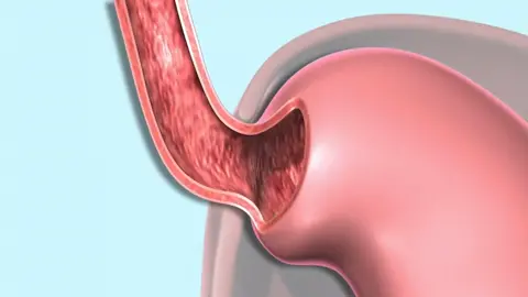 GERD | Gastroesophaheal Reflux Disease #gastritis #maag #gerd #asamlambung #fyp #fypシ゚viral #edukasi #animasi 