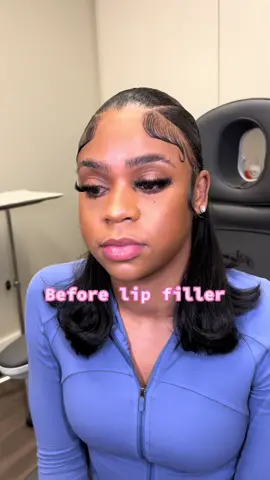 You really have to trust the process 😅#fyp #lipfiller 