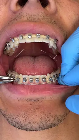Braces transformation part 2 🤯 #braces #bracestips #bracesoff #fyp #viral #food #candy #bracescolors #transformation #sour 