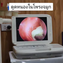 คนไข้มาด้วยอาการคัดจมูก กังวลว่าจะเป็นเนื้องอก คุณหมอเลยส่องเข้าไปดู เจอหนองอยู่ในโพรงจมูกร่วมกับอาการบวม #คัดจมูก #ปวดจมูก #ปวดเบ้าตา #ไซนัสอักเสบ #ไซนัส #ราชวิถีหูคอจมูกคลินิกเชียงใหม่ 