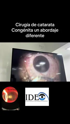 Cirugía de Catarata Congenita,un abordaje diferente #tiktok #fyp #foryou #foryoupage #ojos #ideovzla #imagen 