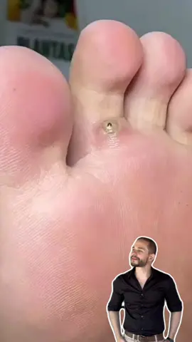 O bicho de pé é um problema de saúde causado por um tipo de pulga denominado Tunga penetrans. Essa pulga, tanto macho como fêmea, se alimenta de sangue, porém, somente a fêmea, após ser fecundada, penetra na pele de pessoas e de animais, onde iniciará o processo de amadurecimento de seus ovos, eliminando-os no meio ambiente. Qualquer parte do corpo que fique exposta ao parasita poderá ser atingida; normalmente as que ficam próximas do solo são as mais afetadas, como: a planta dos pés, os dedos, ao redor das unhas e calcanhares. Os parasitas devem ser retirados por profissionais de saúde com os devidos cuidados de higiene, após a lavagem e desinfecção da área atingida, utilizando agulha esterilizada. Em casos de infestação grave pode ser necessária a hospitalização do paciente para que o procedimento seja feito com intervenção médica, inclusive com uso de anestesia, antibióticos e imunização contra o tétano.