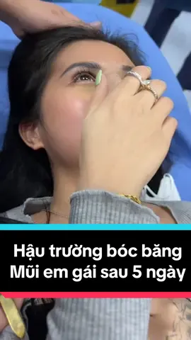 Hậu trường ekip bs bóc băng siêu phẩm mũi em gái sau 5 ngày đẹp xuất sắc #xuhuong #LearnOnTikTok #nangmui #nangmuiphongthuy #nangmuicautruc #nangmuisline 