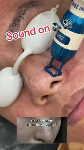 Harmony IPixel for deep acne scars on your cheeks, nose, and temples. Try this innovative procedure in removing your baku-baku. Book an appointment with us TODAY! Exclusively available at📍Savouge Aesthetics BGC Taguig #acnescar #bakubaku #alagangsavouge #savougeaesthetics 