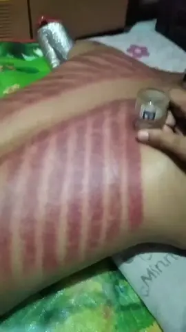 adu mekanik merima jasa kerik pake botol balsem #fypシ゚viral  #fyp  #kerikbotolbalsem #tiktok 
