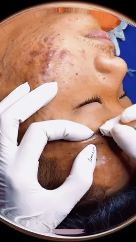 Relaxing 5 #ance #squeeze #pimple #satisfying #fyp #acne #unhaencravada #tratamento #Pickel #brufolo #soddisfacente #blackhead #blackheadsremoval #viral #foryou
