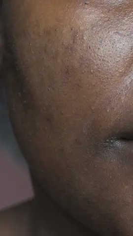 TUDO SOBRE MELASMA NA PELE NEGRA 😉 #melasma #antimelasma #antimanchas #manchas #pelemanchada #manchadesol #pelenegra #pele #skincare #skin #tratamentomelasma 