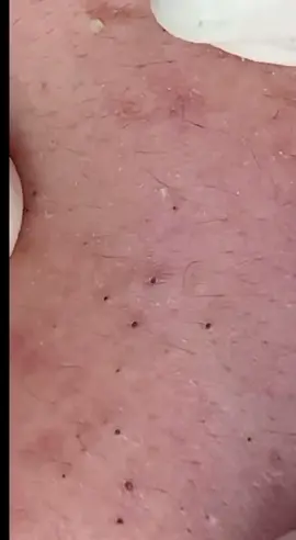 #removalvideo #extractions #satisfying #blackhead 