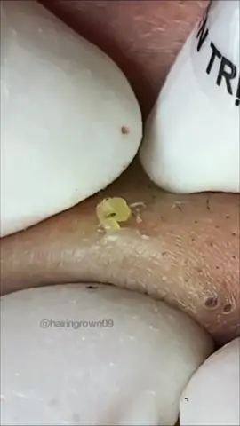#extractions #satisfyingremoval #satisfyingvideo #pimpleremover #blackheadsremoval 