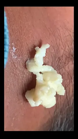 #cyst #extractions #satisfying #video #fy #pimple 