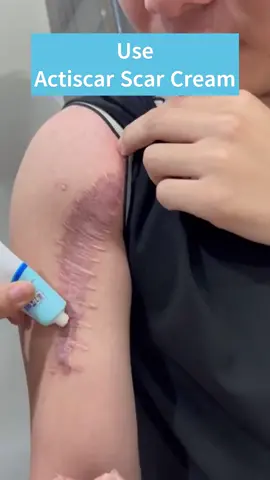 Keloid scars - concave scars are no longer a concern #scar #actiscar #fyp #trending #foryou #removal