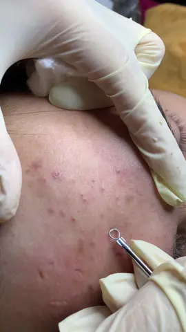 Tập 4 nặn mụn một bốn chính cành #lqspa #chamsocdamat #hocnghespa #điều_trị_mụn_nám_rỗ_tàn_nhang #lequynhspa #vienthammylqsaigon #vienthammylqspa 