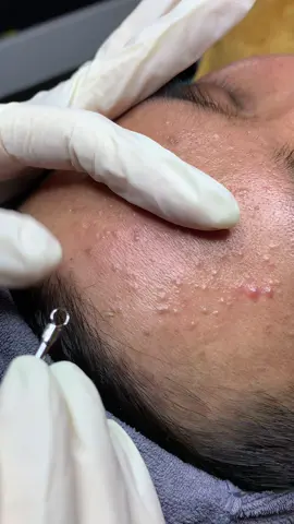 Khách nói coi miết không chán ca mụn xuyên đêm  #hocnghespa #lqspa #vienthammylqspasaigon #chamsocdamat #vienthammylqspa 