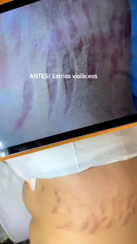 Método Dermo Strit para tratamento de estrias 🤍 •Um método inovador e transformador! . #transformador #dermostrit #estrias #adeusestrias 
