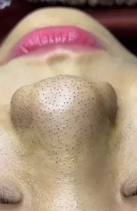 #granosyespinillas #viral #parati #satisfying #satisfaction #satisfyingvideo #puntosnegros #blackhead #CleanTok #granos #limpiezafacial #pimple #nariz #filamentossebaceos #pimplepop #foryou 