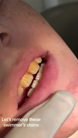 This is the yellowing or browning of the teeth that many swimmers notice after regularly swimming at the pool for long periods of time. #dentalhygiene #myfirstdentist #premierdentalgroup #pediatric #bahamas