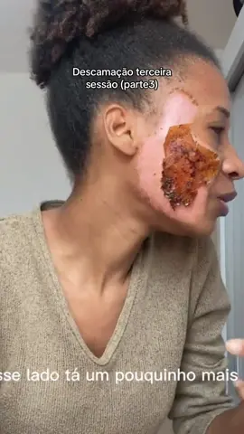 Descamação da terceira sessão (parte3)   ##refineskin##peeling##peelingquimico##fenol##skin##medico##fy##medicina##antesdepois##estetica##beleza##cicatrizesdeacne##esteticista##dermatologia##reidofenol##phenolgold##tratamentoparacicatrizes##estéticafacial##estética##biomedicinaestética