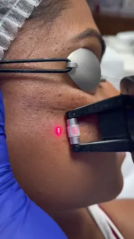 Relissage au laser #cicatriciacnee #cicatrice #laser #centrelaserpalaiseau #essonne #essonne91 #laserfractionné #fraxellaser #laserparis 