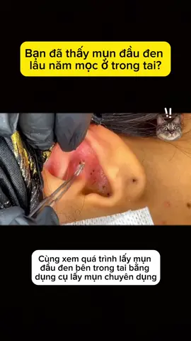 Lấy mụn đầu đen mọc bên trong tai #nanmun #mundauden #bonanmun 
