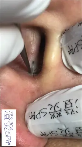 #blackhead #pimple #pimplepoppersatisfying 