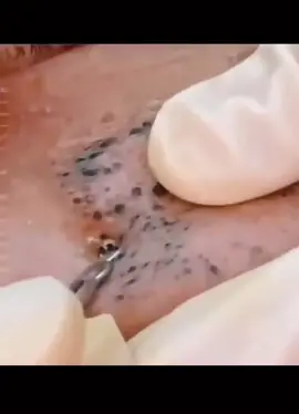 #removalvideo #extractions #satisfying #blackhead 