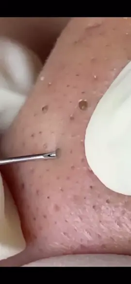 #pimples #satisfying #blackheads 