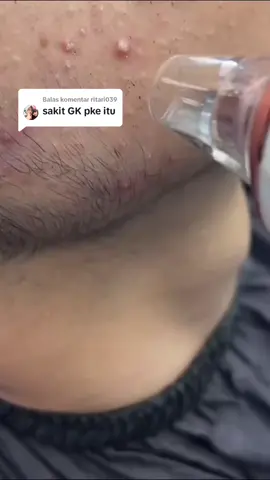 Membalas @ritari039 pakai pelembab dlu ya bun biar ngga skit🥰 #vacumkomedo #alatpenyedotkomedo #komedohilang 