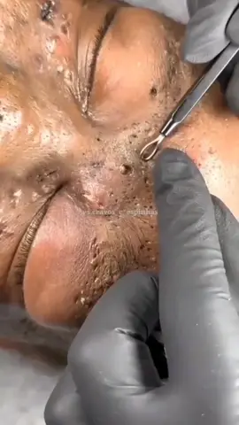 #cravo #cravos #pimple #blackhead #espremendocravos #pimplepop #blacheadsremoval #acne #satisfying #fy #viralvideo #relaxing 