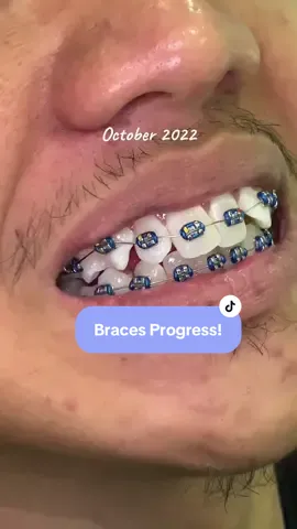 8 months braces progress🦷✨ #braces #foryou #fyp #klinikgigijohorbahru #doktergigi 