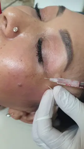 Botox to minimize Wrinkles  Botox last for 4-6months  🔔Book an appointment ☎️01-5908320  Kumaripati, Lalitpur  1st floor of Global IME Bank  #rubyranashah_first_miss_nepal #dermatologist #aestheticdoctor #aestheticnurse #dermdynamics #botulinumtoxin #nomorewrinkles #antiaging 