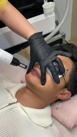 #fypシ #fyp #jember #jembercantik #picolaser #laserrejuvenationjember #laserliprejuvenation #bibirhitam 