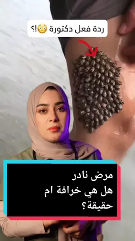 مرض غريب جدا 😳يرقات حشرات تلتصق بالجسم 🐛  هل هي خرافة ام حقيقة؟ #دكتورة  #طبيبة #طبيب #صحة  #معلومات  #doctor #health #information  #امراض_نادرة #ترند #امراض_غريبة