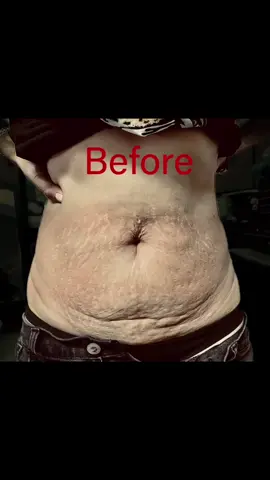 #coverup #bellystretchmarks #annahangtattoo