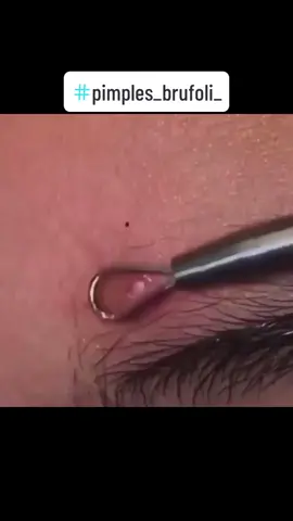 #pimples_brufoli_ #blackhead #zit #brufoli #pimples #pimplepop #acne #pimple #pimples_brufoli #foryou #fyp #popping 