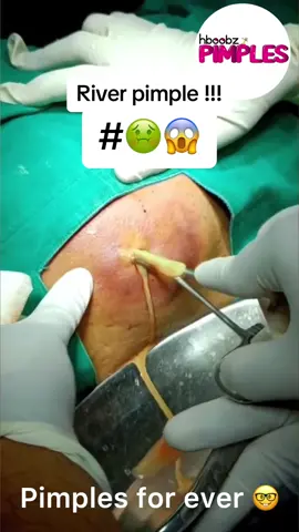 #pimples #cyst #pimple #horror #medical #blackhead #bigpimple #pimpleremoval #disgusting #pimplepop #cystexplosion #squeeze #creepy #ufo #satisfying #verysatisfying 