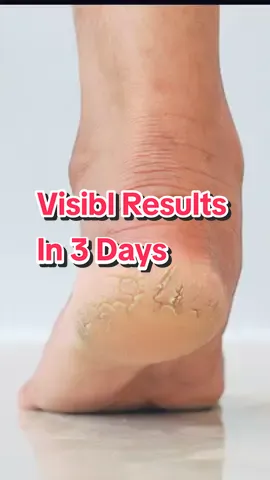 Recommended for adults and children over the age of 12 years. Stinging may occur in deep cracks. #crackheel #crackheelshomeremedy #crackheelsolution #crackheeltreatment #crackfeet 