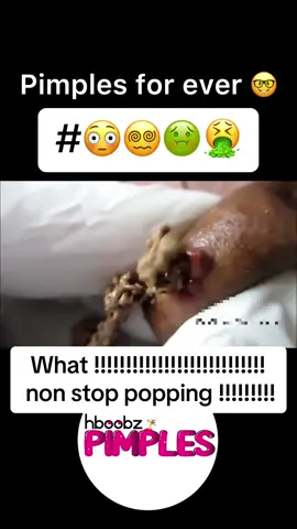 #pimples #pov #fortnite #pimpleremoval#comediantiktok #fyp #pimplepop #fail #capcut #foryou #viral #SkinCare #PimplePop #acnejourney #skincare  #SoinsVisage #blackhead #routine #routinebeaute #pimple #medical 