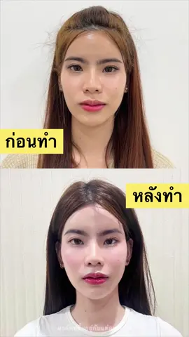 ยกสุด ยกทั้งปี ยกยาวๆ ยิ่งทำคู่โบ หน้ายิ่งเป๊ะ แนะนำ Ultrfomer เลยค่า #bkkbeautyclub #ultrafomerlll #หน้ายกกระชับ 