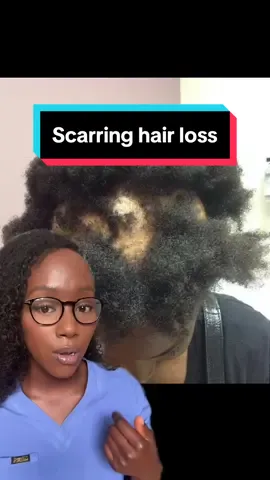 CCCA is the most common cause of hair loss in black women. We need a lot more research to go into it, as the cause has probably been wrongly attributed to hair practices over the years. #CCCA #alopecia #hairlossblackwomen #4chair #hairtok 