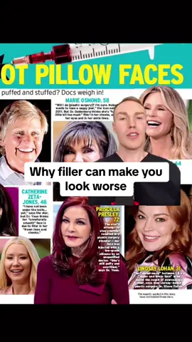 Too much dermal filler can make you look worse. Overfilled faces are on the rise, which is why I always emphasise the importance of choosing your injector wisely #dermalfillers #pillowface #pillowfacefilter #overfillersyndrome #overfilledface #overfilledfacesyndrome #overfilledlips #fillergonewrong 