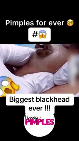 #pimples #cyst #pov #foryou #viral #pimple #acne #skincare #blackhead #bigpimple #pimpleremoval #pimplepop#satisfying #squeeze #medical #disgusting #cystexplosion 