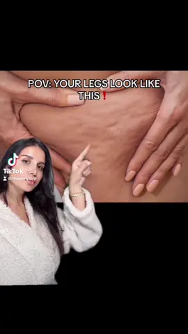 Save, download, and try this cellulite reduction hack ❤️ #skintightening #skintighteningoil #postpartum #cellulite #postopcare #postopmassages #postopsupplies #postoprecovery #bodycare #bodycontouring 