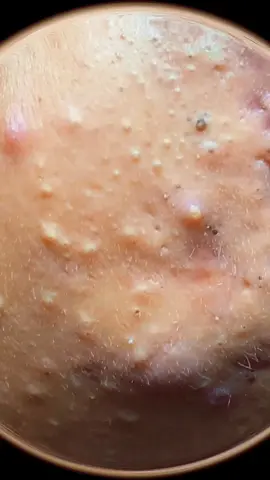 Ive never had such a high quality cideo sent to me before #pop #pimple #satisfying #fyp 