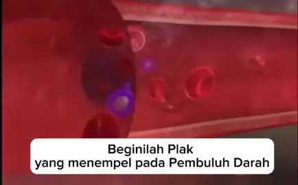 BERSIHKAN FLAK UNTUK HINDARI PENYUMBATAN  #hidupsehatmenebarmanfaat #hidupsehat #turunbb #regenerasisell #regenerasisell #jantungsehat #dietsehat #diet #diet #fyp #motivasi #inspirasi 