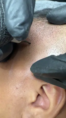 Working on sideburns. @TheMicropigmentationInstitute  #scalpmicropigmentation #SMP #hairlosssolutions #alopecia #fyp #hairtok #Bulacan #hairtattoo #fypシ 