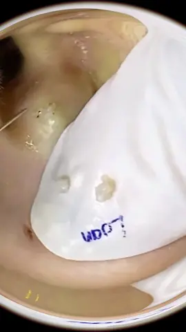 #squeeze #pimple #satisfying#fyp#acne#unhaencravada#tratamento#Pickel #soddisfacente#brufolo#blackheadsremoval#earwax#ear#seattle#Toronto#viral#foryou