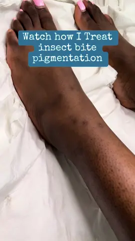 Treating insect bite pigmentation. #insectbite #legs #southlondon #brixtonlondon #pigmentationremoval #insectbitesremoval 