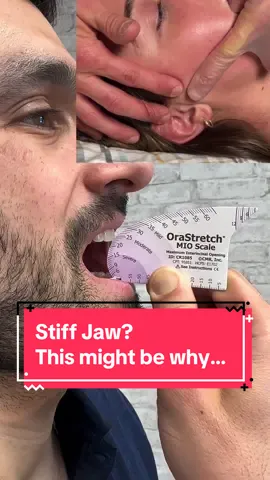 Do you have jaw stiffness? Maybe you’re unable to open wide enough to eat or to talk or even to have any dental procedures? Well, there are various reasons for why this could be depending on how far you can open your mouth. If your mouth is very limited and you cannot open beyond 20 mm then more than likely it’s what we call trismus meaning that there’s muscle spasms and joint restrictions or scar tissue that need to be taken care of. If you can open up a little bit more closer to 30 mm it might be a joint mechanics problem where you can rotate but you can’t translate the TMJ. And beyond that if it’s painful, there may be a disc displacement issue or other mechanical issues as well. There are many strategies we can use to get you opening your mouth so you can live a functional life it just depends on exactly what the history is and how far wide you can open at this point in time. #tmj #tmjdisorder #tmd #tmj👊 #tmjmassage #tmjtreatment #jawmanipulation #jawpain #dentalimplants #rootcanal #dentistry 