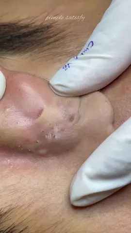 Comment your reaction ❤️ #pourtoi #tiktoklongs #foryou #relaxing #fyp #satisfying #pimple #blackheads 